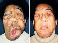 Yüz ve el nakli yapılan hasta öldü