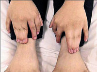 31 parmaklı çocuğa başarılı operasyon