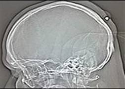 Kafasında mermiyle 5 yıl yaşadı