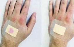 Akıllı yara bandı