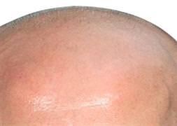 Kellik kanser habercisi mi?