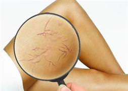 Artan varis ağrılarına dikkat!