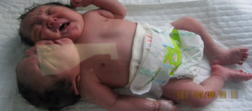 İki başlı kız bebek doğdu-1