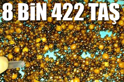 Safra Kesesinden 8 bin 422 taş çıkarıldı