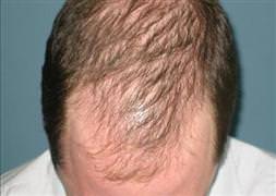 Kelliğe neden olan bir protein bulundu