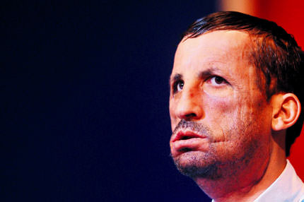 Yüz nakline yüz bin TL