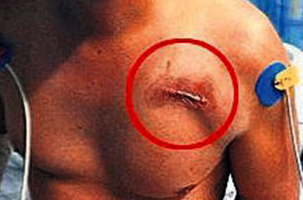 Hollywood usülü ilk yardım