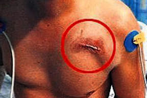 Hollywood usülü ilk yardım