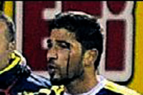 Kaşım yarıldı oyun durmadı...