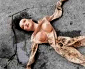 Şişme kadın operasyonu