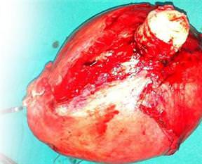 Karnından 25 kiloluk kist çıktı