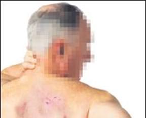 Karısı üzerinde sigara söndürdü