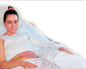 Kaynar suya ağır ceza