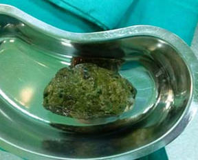 Midesinden kocaman taş çıktı