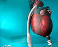 Yapay kalple 75 gün yaşadı