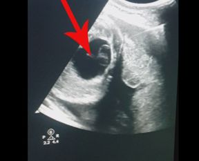 Anne karnındaki bebeğe ameliyat