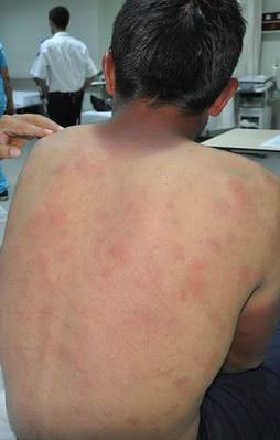 Şiddetli dolu yağışı hastanelik etti