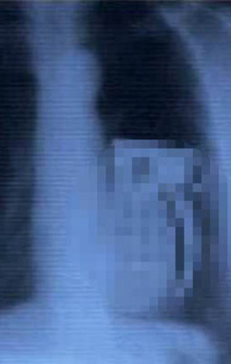 Midesinden çıkan kan dondurdu!