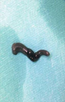 Sesini kısan sülüğü çıkardı