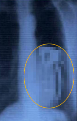 Midesindeki cismi görenler donup kaldı