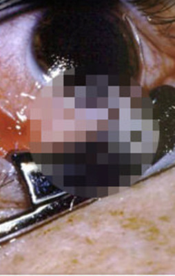 Dikkat! Eğer gözünüzde sulanma varsa...