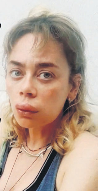 Demet Evgar nazara geldi! Arı soktu, merdivenden yuvarlandı...-1