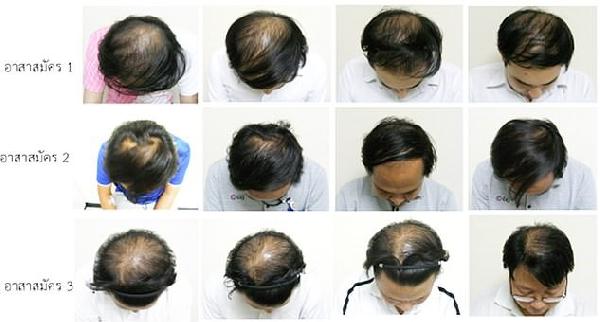 son-dakika-kelligin-ilaci-bulundu-taylandli-bilim-insanlari-mangrov-agacinin-ozuyle-kellik-sorununu-kaldirdi-1611907878420.jpg SON DAKİKA: Kelliğin ilacı bulundu! Taylandlı bilim insanları mangrov ağacının özüyle kellik sorununu kaldırdı-2