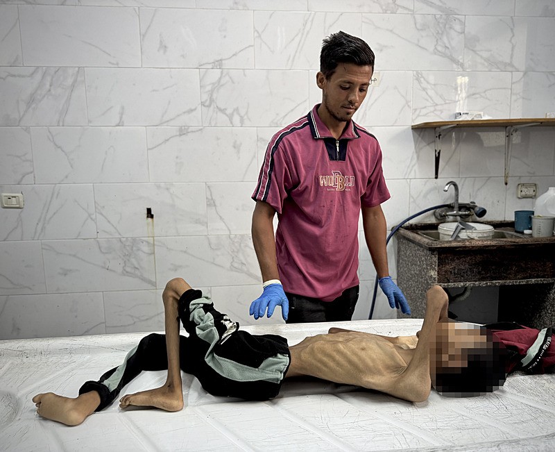 Gazze'de açlık ve yetersiz beslenme can almaya devam ediyor