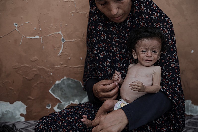 Gazze'de 5 aylık bebek açlık nedeniyle hayati tehlike altında, AA