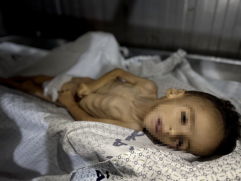 İsrail'in yoğun kuşatma ve kısıtlamalarla temel gıda erişimini engellediği Gazze Şeridi'nde, 5 yaşındaki Muhammed Zekeriya Hıdır isimli çocuk, yetersiz beslenme nedeniyle hayatını kaybetti, AA