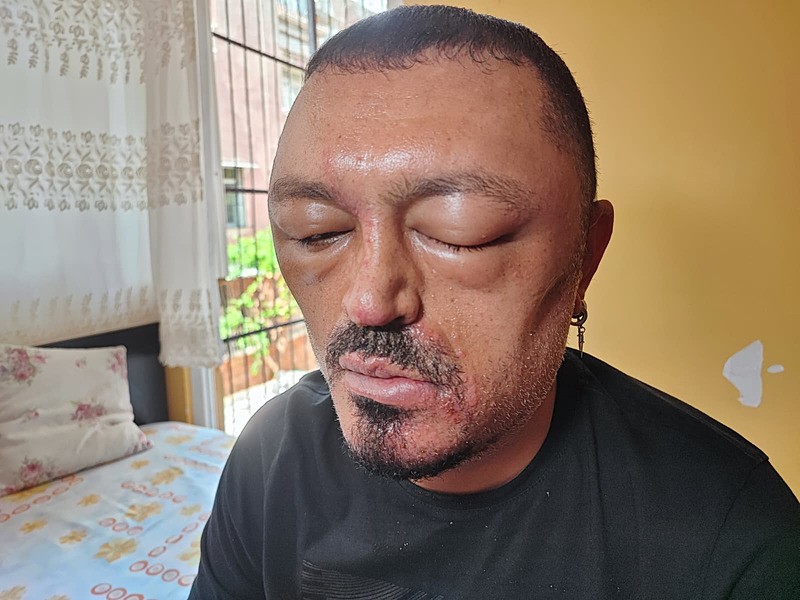 Saçlarını siyahlatmak için aldığı şampuanı kullandıktan sonra yüzü gözü şişti (Fotoğraf: İHA)