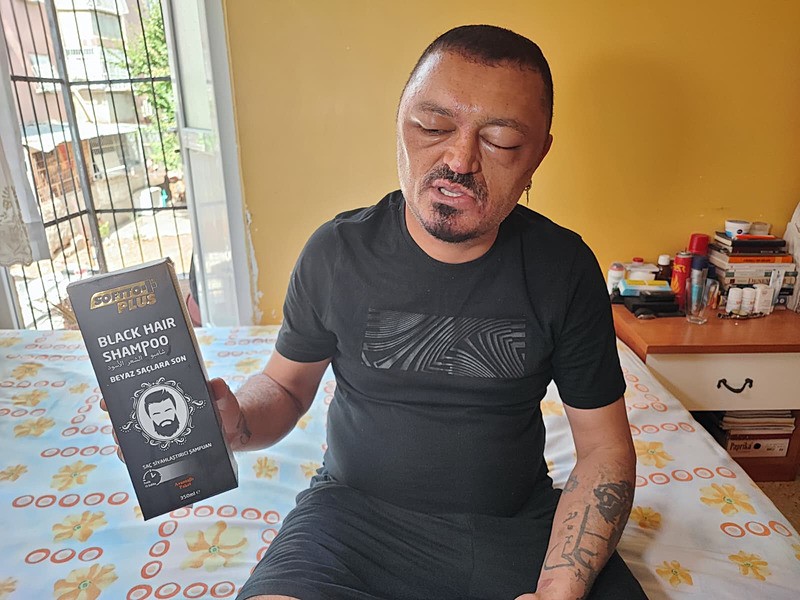 sampuan-faciasi-dayak-yemisten-beter-oldu-1757149065164.jpeg Saçlarını siyahlatmak için aldığı şampuanı kullandıktan sonra yüzü gözü şişti (Fotoğraf: İHA)