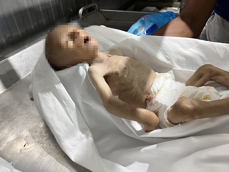 Gazze’de yetersiz beslenme nedeniyle bir bebek daha hayatını kaybetti (AA)