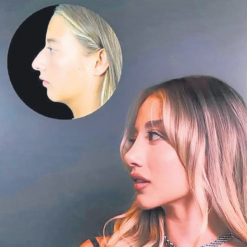 Burun estetiği olan Aleyna Kalaycıoğlu eski halini yerdi: "Çok çirkinmiş!"-6