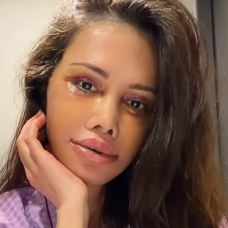 Didem Ceran'ın yüz nakli sonrası inanılmaz değişimi-6