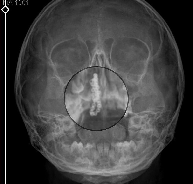 Rize'de inanılmaz olay: 5 yaşındaki çocuğun burnundan tırnak makası zinciri çıktı-3